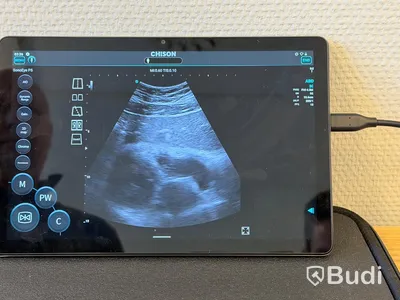 Ultraljud, Chison SonoEye P5 med Lenovo tablet