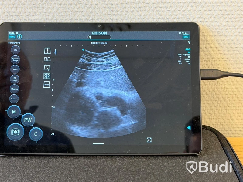 Ultraljud, Chison SonoEye P5 med Lenovo tablet