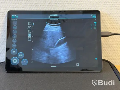 Ultraljud, Chison SonoEye P5 med Lenovo tablet