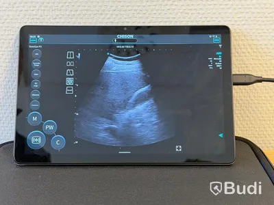 Ultraljud, Chison SonoEye P5 med Lenovo tablet