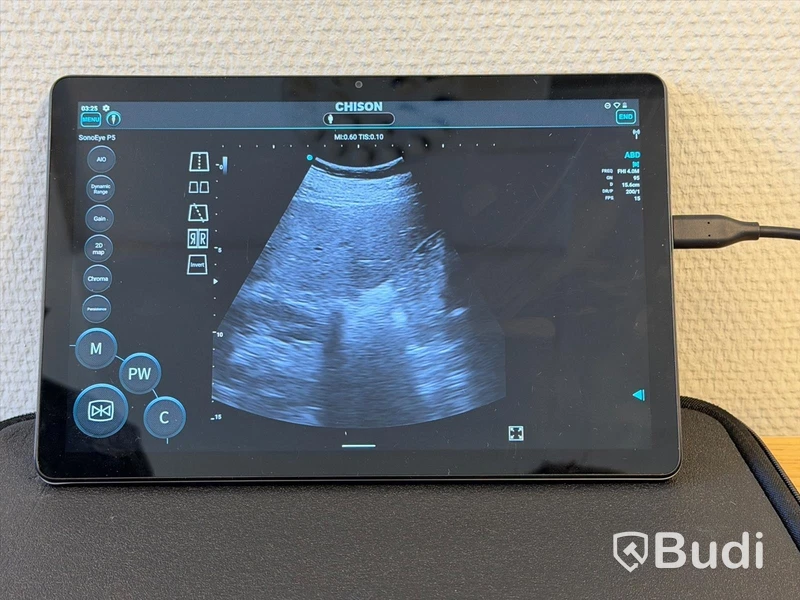 Ultraljud, Chison SonoEye P5 med Lenovo tablet