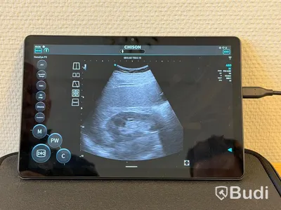 Ultraljud, Chison SonoEye P5 med Lenovo tablet