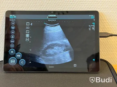 Ultraljud, Chison SonoEye P5 med Lenovo tablet