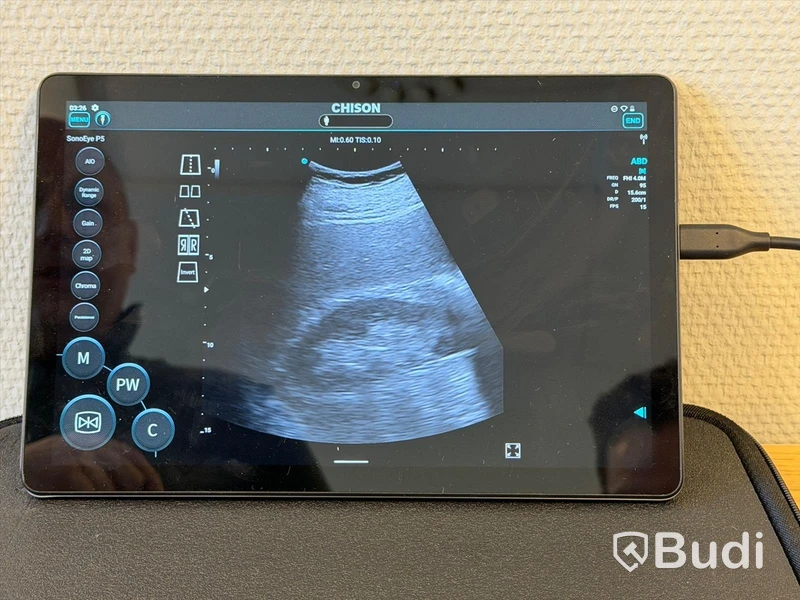 Ultraljud, Chison SonoEye P5 med Lenovo tablet